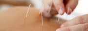 Acupuncture Acupuncture