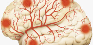 Stroke