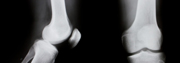 Bone & Joint Injuries Bone & Joint Injuries