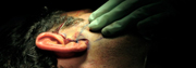 Ear Injury Ear Injury