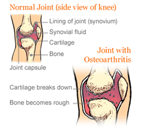 Are You Killing Your Knees? Are You Killing Your Knees?