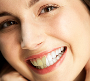 About to Whiten Your Teeth? Read This First! About to Whiten Your Teeth? Read This First!